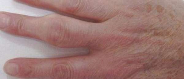 Почему опух палец на руке